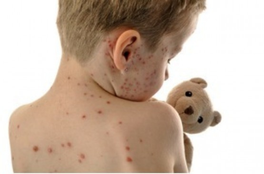 Farmaco antimorbillo